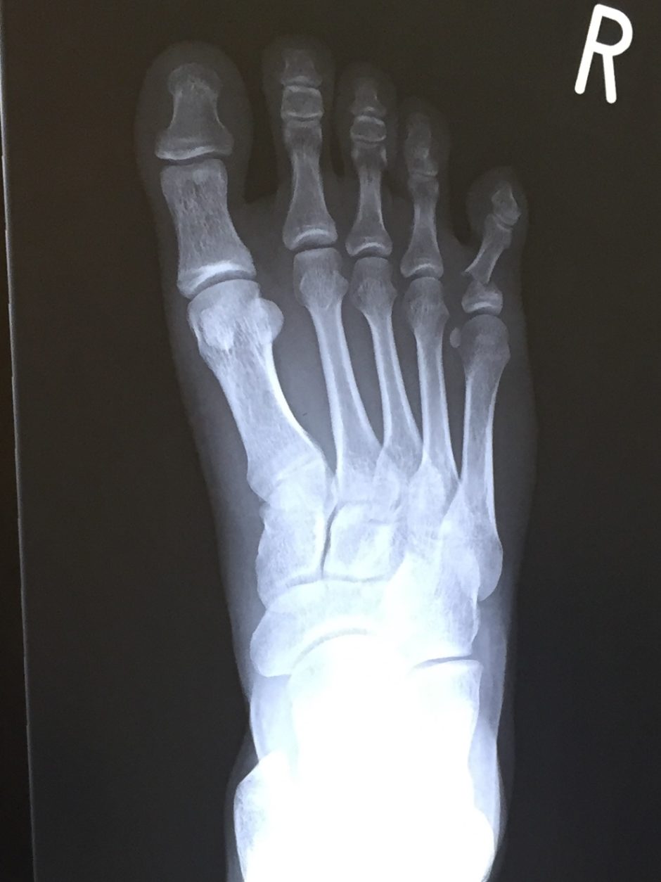 足の小指を壁の出っ張りに強打 右足第5基節骨骨折 くぼた整骨院