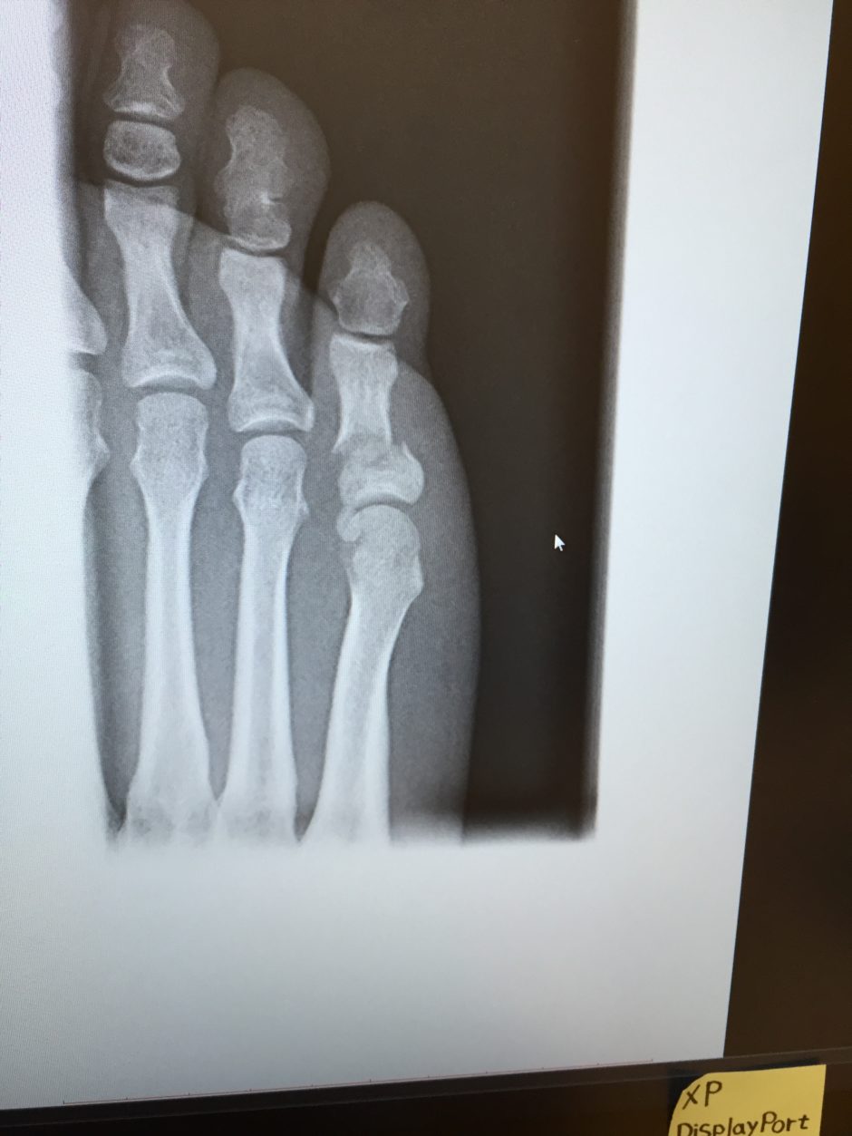 足 の 小指 骨折 レントゲン